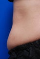 Female treated for Abdominal Fat Bulge