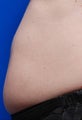 Female treated for Abdominal Fat Bulge