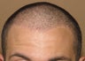 ARTAS robotic hair transplantation
