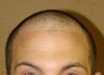 ARTAS robotic hair transplantation