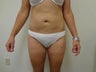 Tumescent Liposuction of abdomen