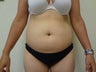 Tumescent Liposuction of abdomen