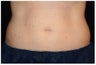 CoolSculpting