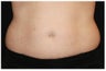 CoolSculpting