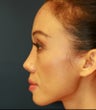 Asian Rhinoplasty