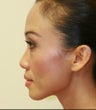 Asian Rhinoplasty