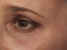 Thermage CPT to Eyes