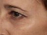 Thermage CPT to Eyes