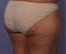 truSculpt