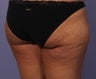 truSculpt