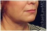 Facial Rejuvenation