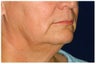 Facial Rejuvenation