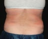 Coolsculpting