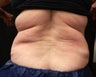 Coolsculpting