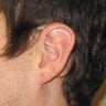 gauge earlobe repair, earlobe reconstruction