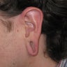 gauge earlobe repair, earlobe reconstruction