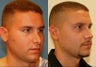 Revision Rhinoplasty
