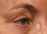 Ulthera