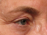 Ulthera