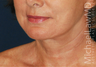 Lower Face Lift