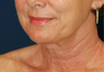 Lower Face Lift