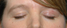 Left brow defect after removal of skin cancer by Mohs surgery
