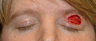 Left brow defect after removal of skin cancer by Mohs surgery