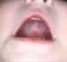 Infant who underwent surgery for a bilateral cleft palate