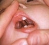 Infant who underwent surgery for a bilateral cleft palate