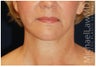 Facial Rejuvenation