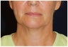 Facial Rejuvenation