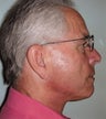 Neck lift in 68 year old man