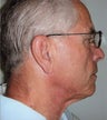 Neck lift in 68 year old man