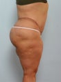 Body Lift