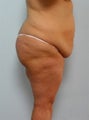 Body Lift
