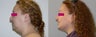 Neck Liposuction