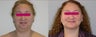 Neck Liposuction