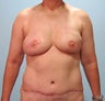 50-year-old female with bilateral immediate DIEP flap breast reconstruction