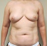 50-year-old female with bilateral immediate DIEP flap breast reconstruction