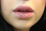 Injectable Fillers & Lip Augmentation