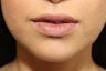Injectable Fillers & Lip Augmentation