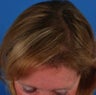 58 year old woman who sought treatment for thinning hair and high hairline