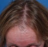 58 year old woman who sought treatment for thinning hair and high hairline