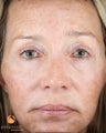 Female After 1 ePrime™: The Evolastin™ Procedure