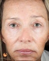 Female After 1 ePrime™: The Evolastin™ Procedure