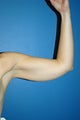 liposuction arms