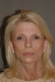 67 Year Old Female Treated for Volume Loss