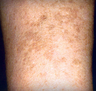 Sunspot Treatment