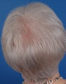 75 year old woman treated with a hair transplant for scarring alopecia