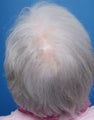 75 year old woman treated with a hair transplant for scarring alopecia